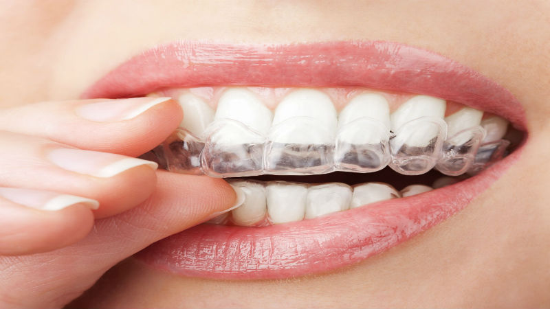 Straighten Your Teeth Through Orthodontic Treatment in Bridgewater NJ