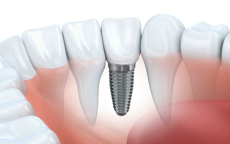 Are You Thinking About Getting Dental Implants?