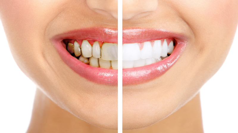 How Cosmetic Dentists in Toms River, NJ Can Change the Appearance of Teeth