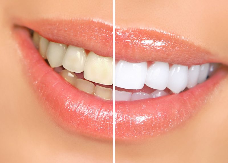 Reasons to Seek Cosmetic Dental Care Services in Ocala