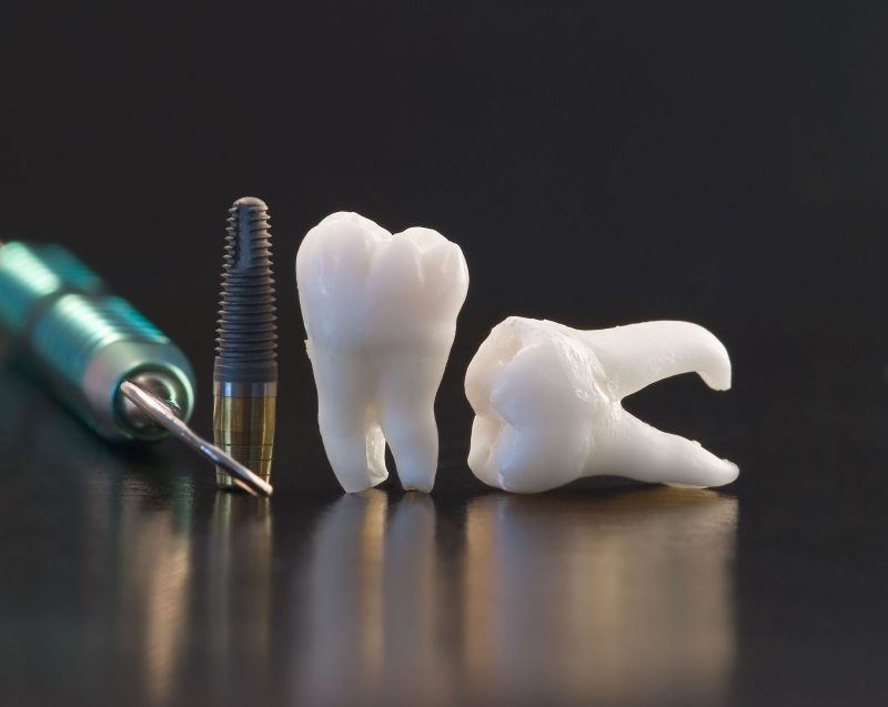 Vital Details About Dental Implants In Nassau County, NY