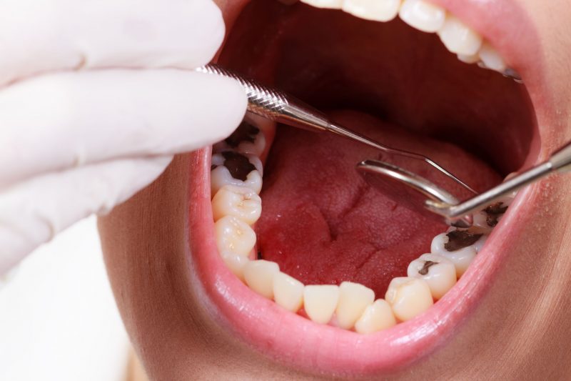 Common Questions Individuals Ask About Teeth Extractions In Del City OK