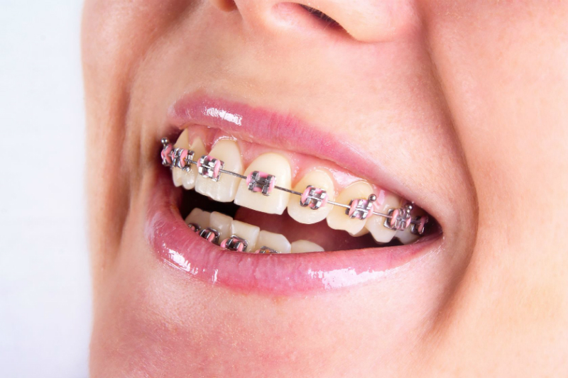 The Advantages of Investing in Teen Invisalign for Your Teenagers