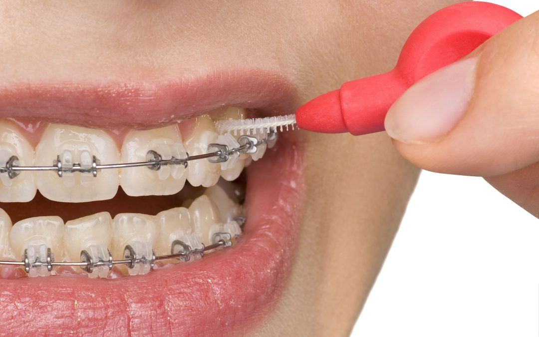 3 Oral Issues That Warrant Orthodontic Treatment in Long Beach, CA